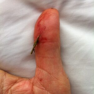Wound 1