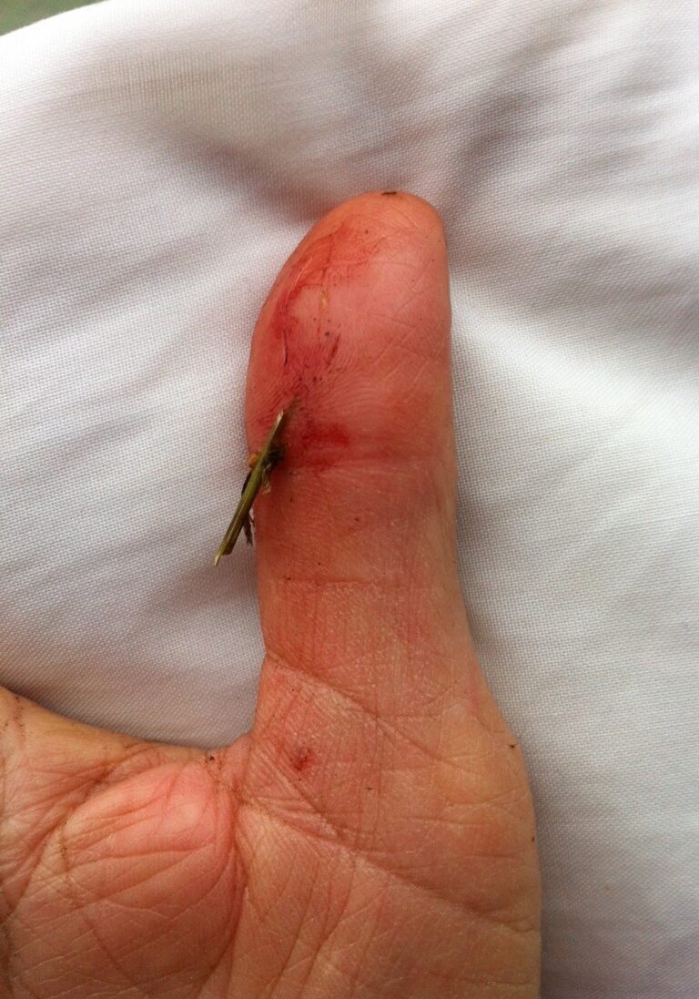 Wound 1