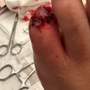 Wound 2